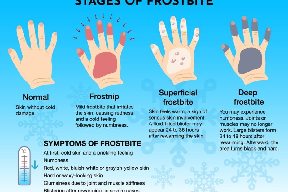 Frostbite Symptoms: How Cold Does It Need To Be To Get It And How Fast Does  It Occur? | The Independent